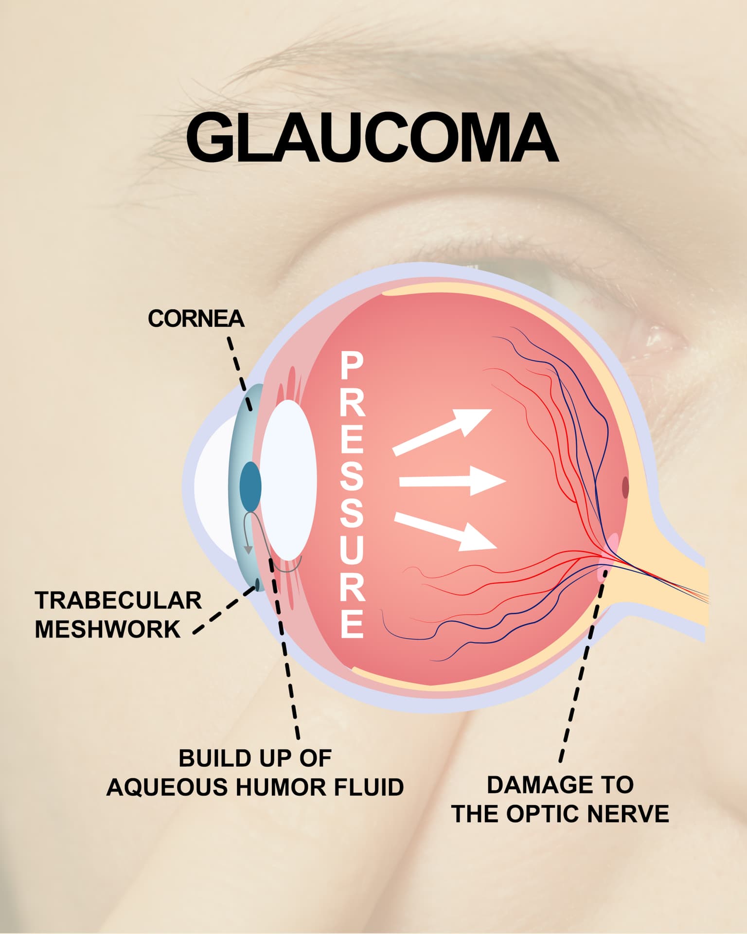 Illustration of glaucoma showing raised intraocular pressure and optic nerve damage