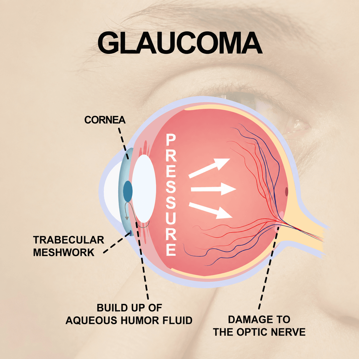 Illustration of glaucoma showing raised intraocular pressure and optic nerve damage