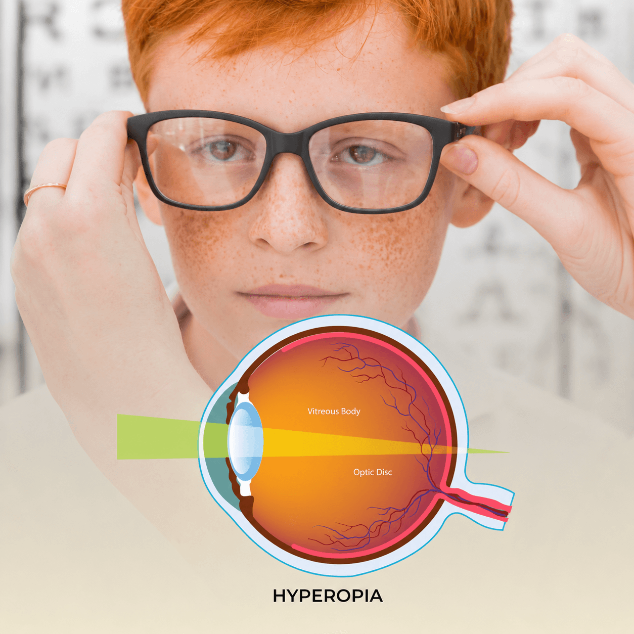 Illustration of hyperopia (long-sightedness) showing light focusing behind the retina
