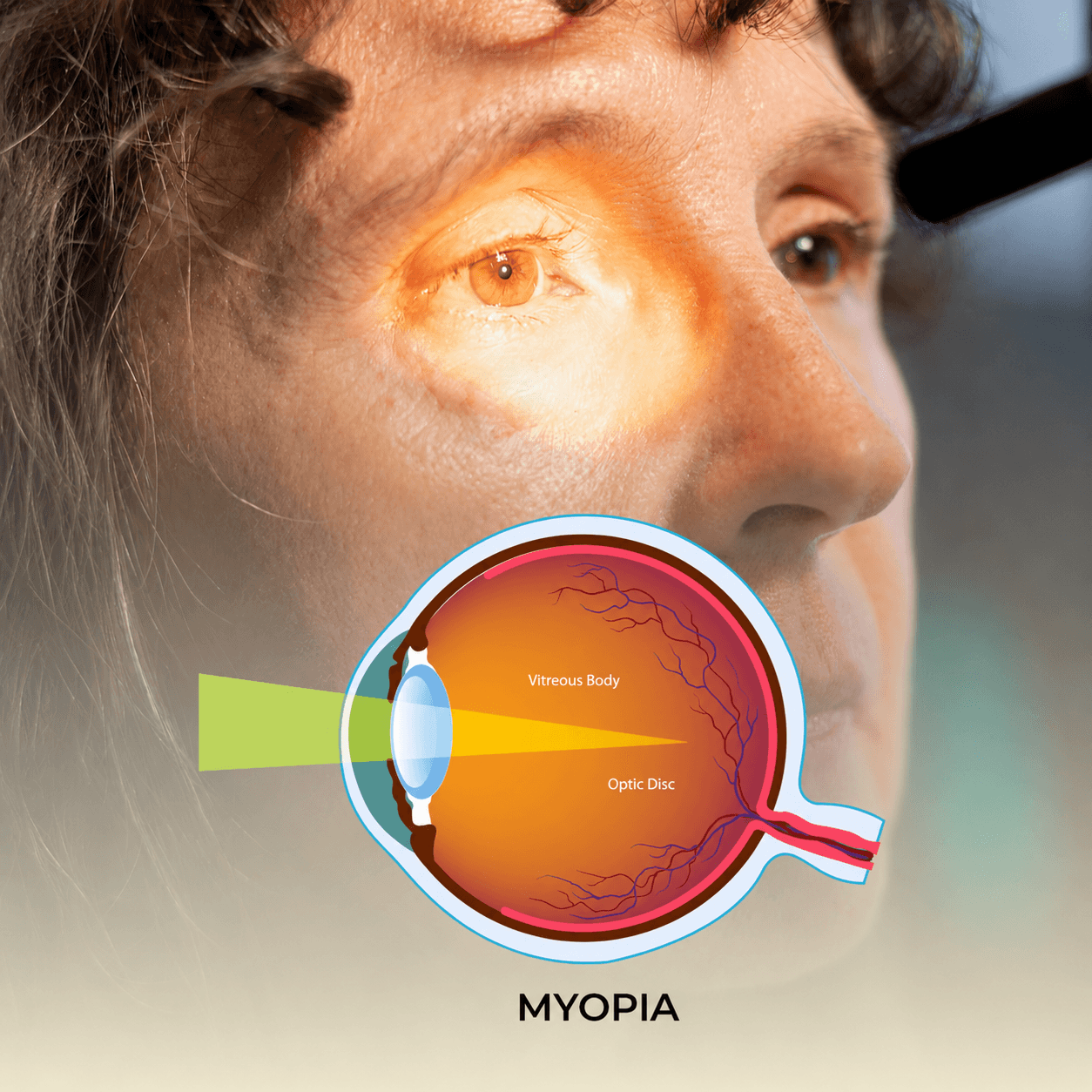 Illustration of myopia (short-sightedness) showing light focusing in front of the retina