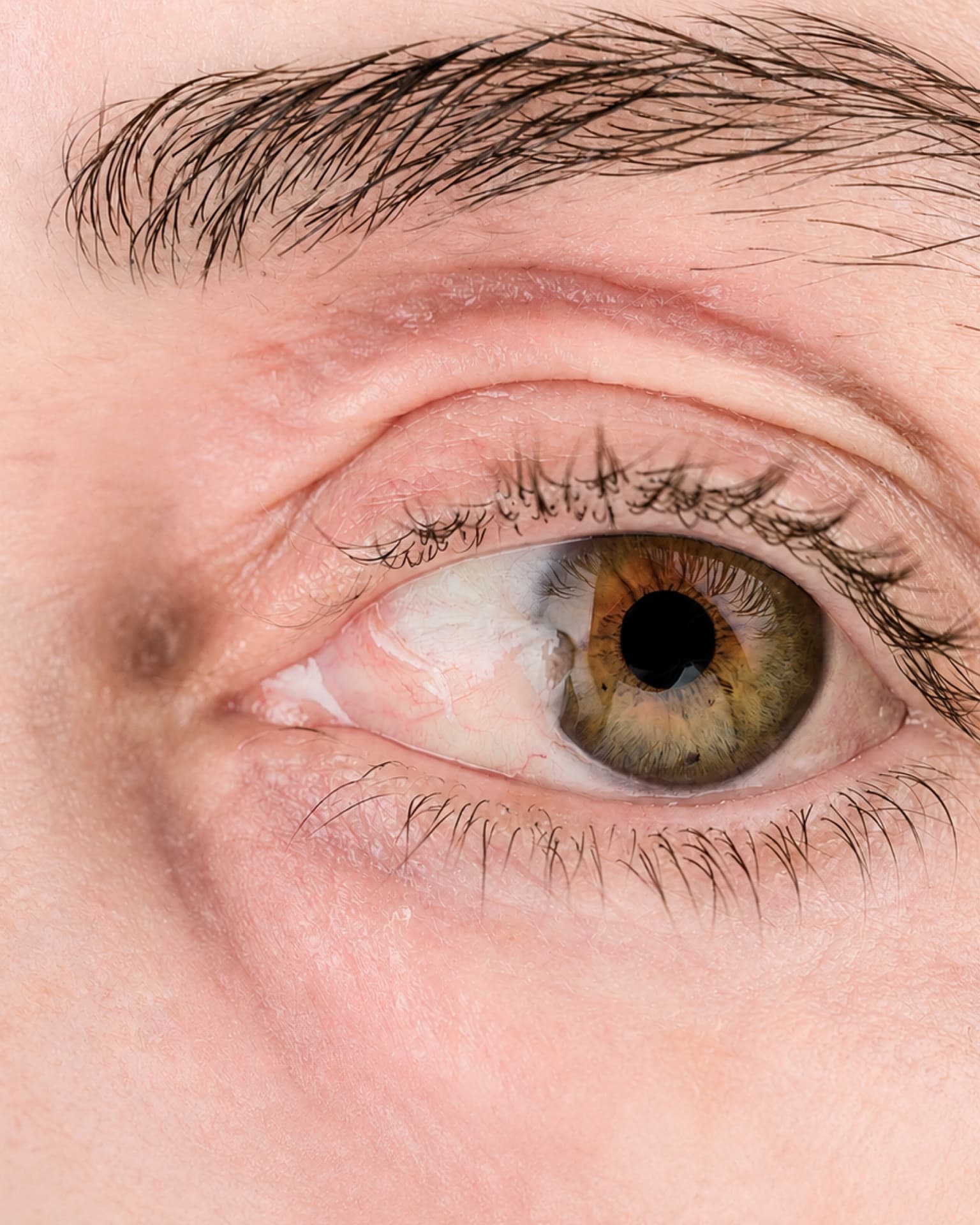 Expert pterygium (surfer's eye) surgery at The Eye Doctor Clinic in Huddersfield