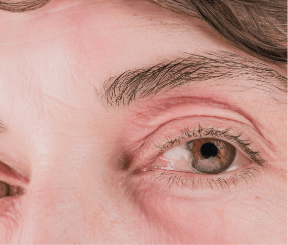 Pterygium removal surgery