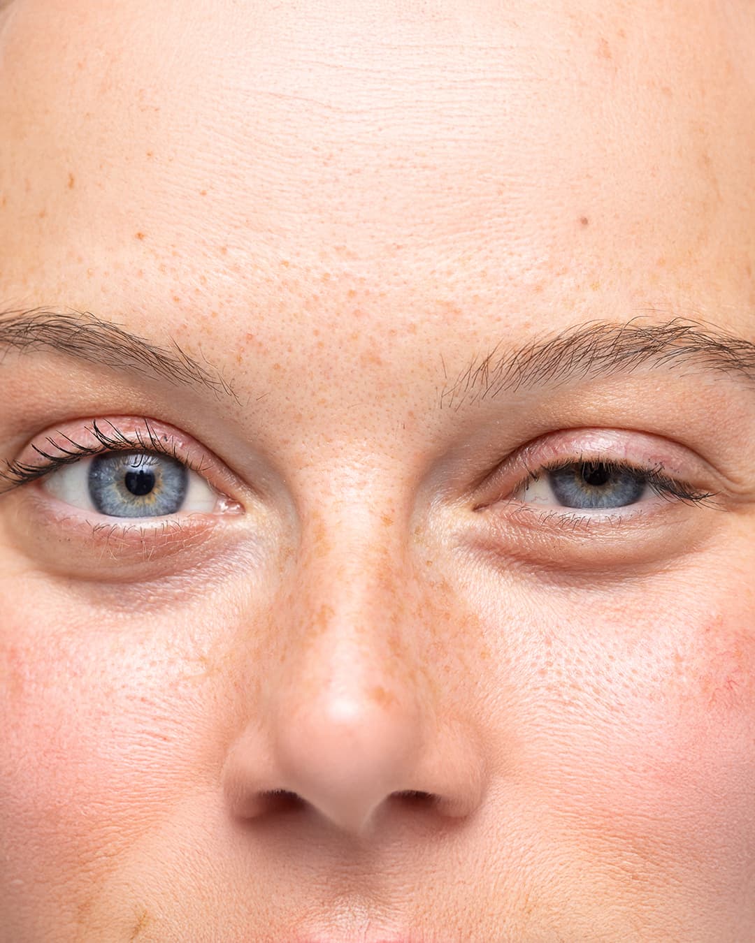 Expert ptosis repair surgery to lift drooping eyelids at The Eye Doctor in Huddersfield