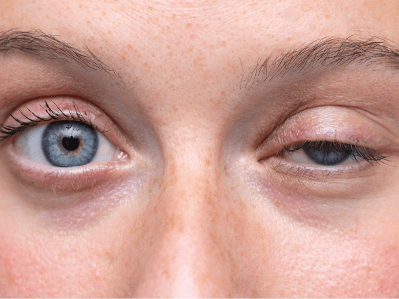 Ptosis (droopy eyelid) repair