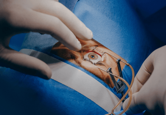 Strabismus (squint) surgery