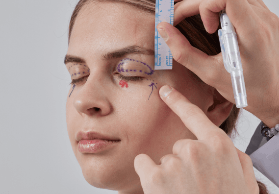 Upper blepharoplasty eyelid surgery