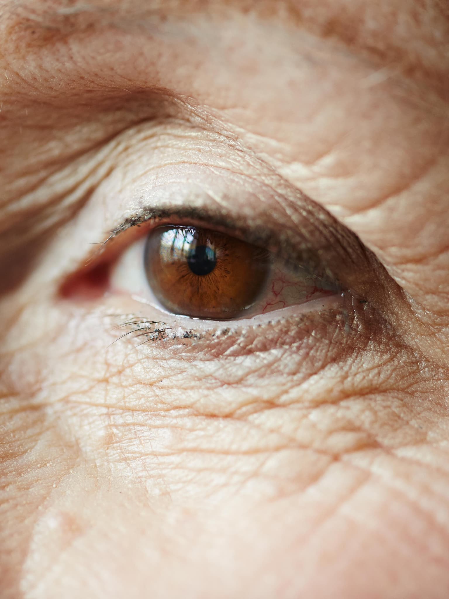 Corneal Surgery