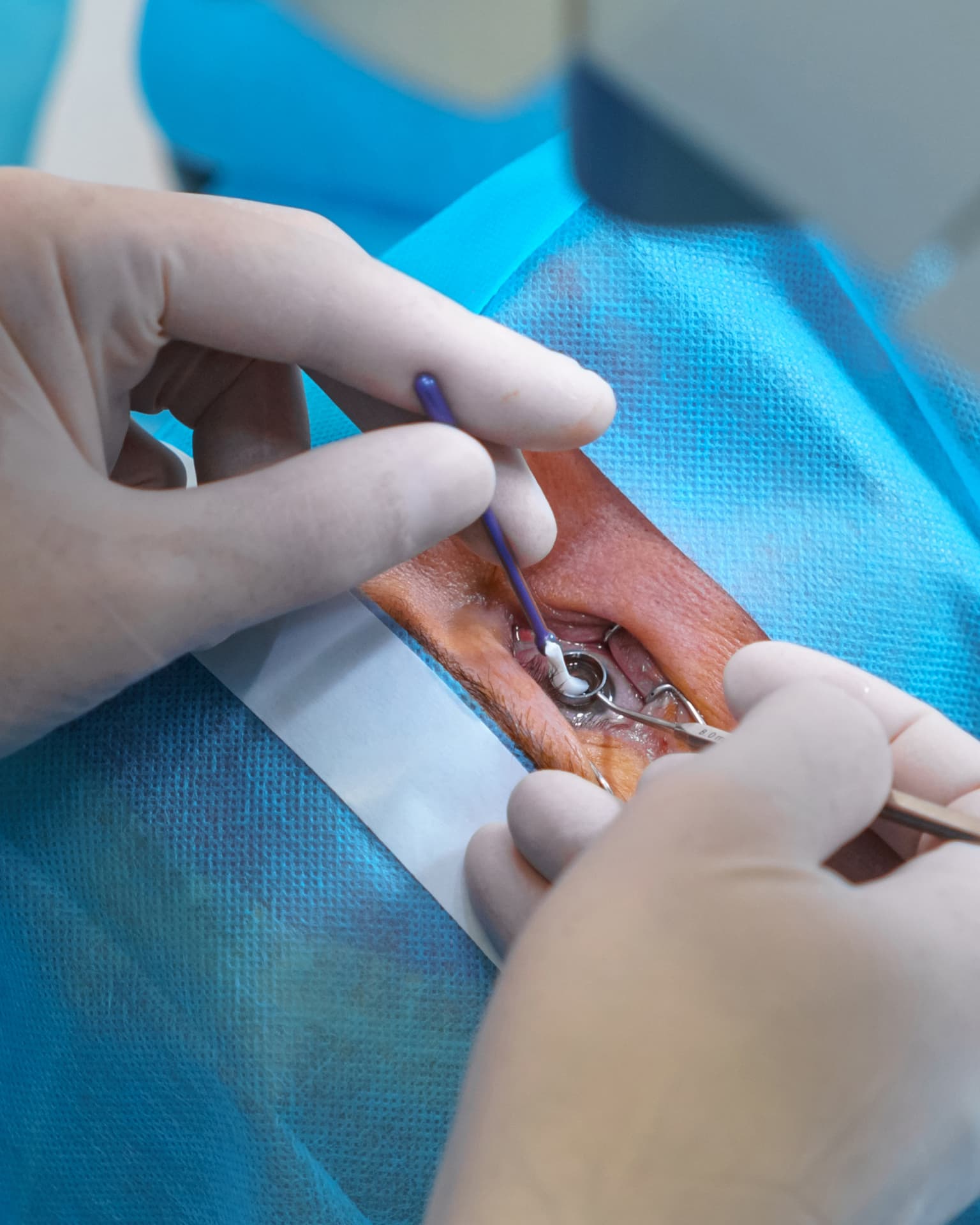 Consultant-led deep sclerectomy glaucoma surgery at The Eye Doctor in Huddersfield