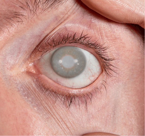 Close-up of an eye with a cataract