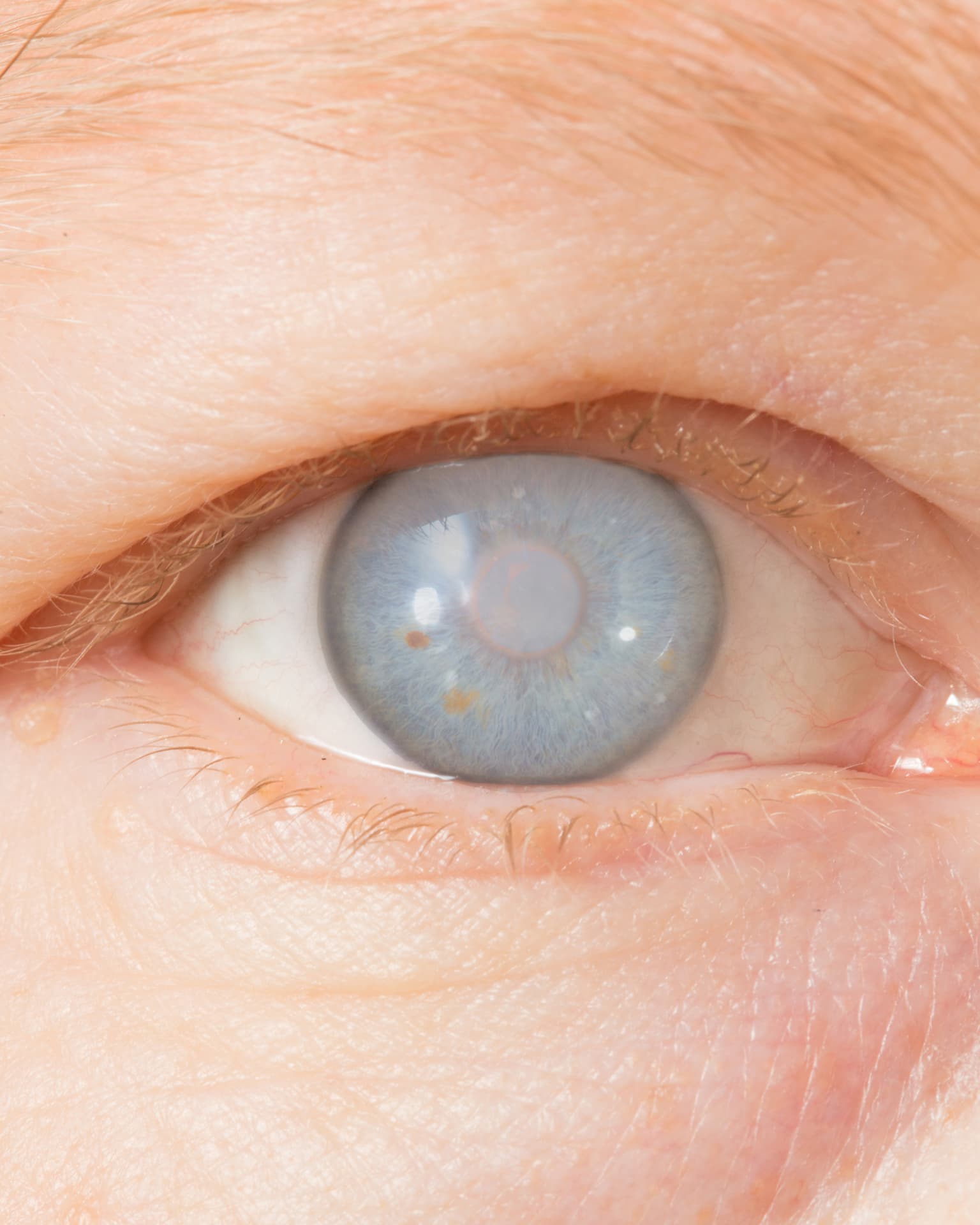 Close-up of an eye with a cataract clouding the lens