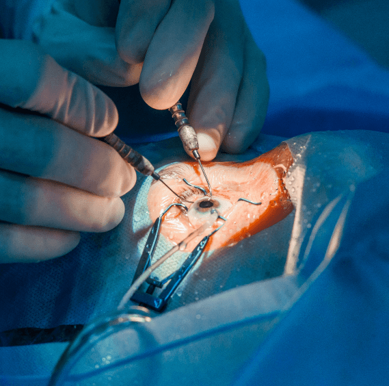 Deep sclerectomy glaucoma surgery