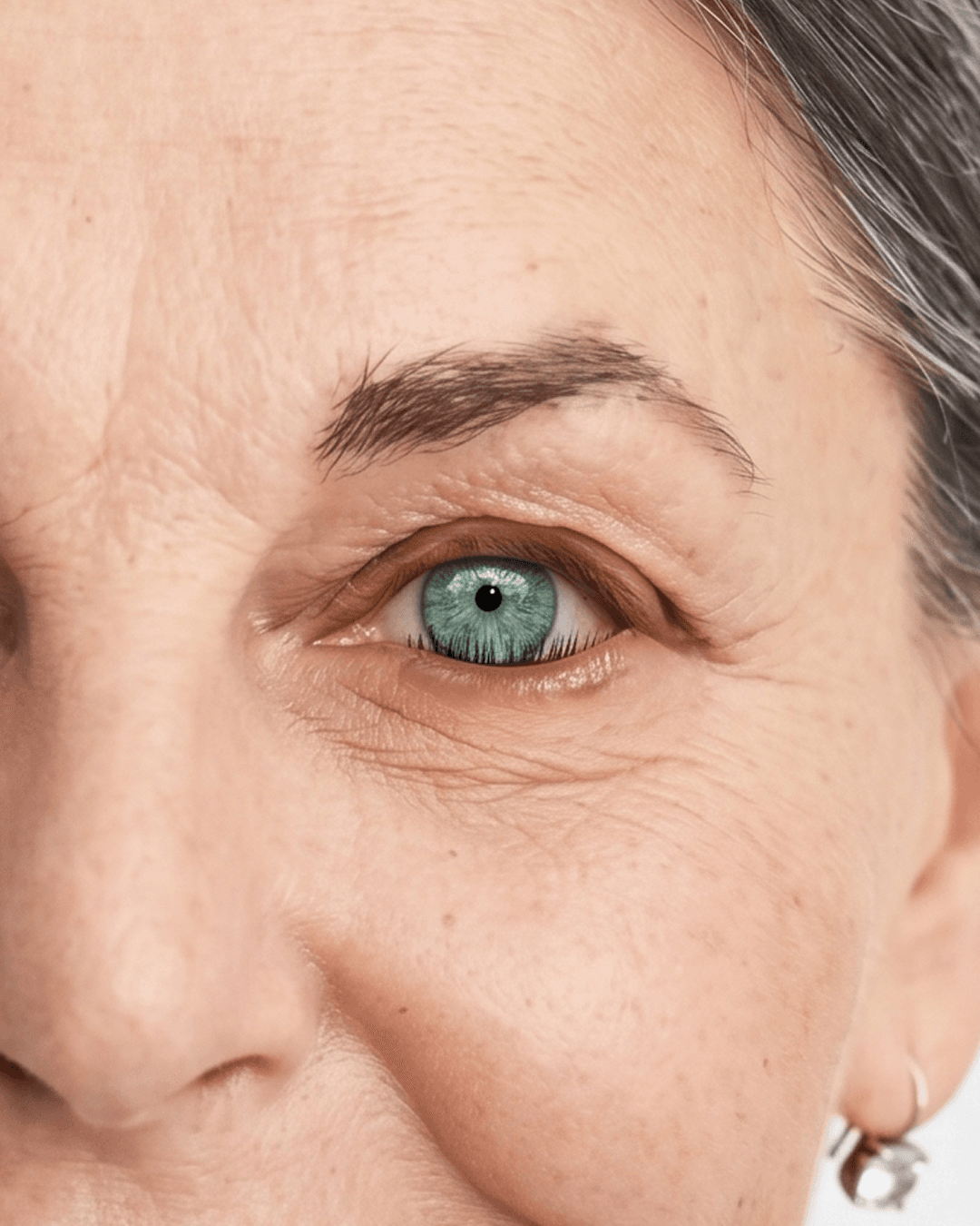 Expert entropion surgery to restore eyelid comfort at The Eye Doctor in Huddersfield