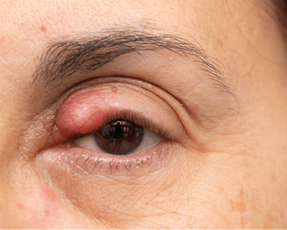 Eyelid cyst removal surgery