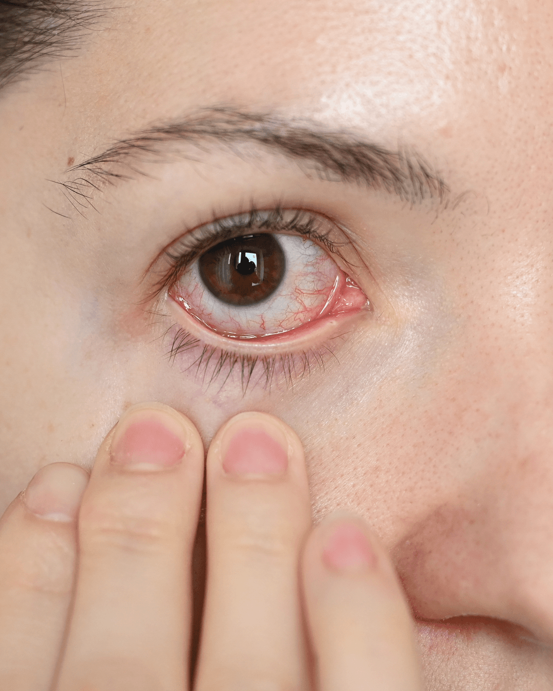 Uveitis eye condition causing inflammation and redness