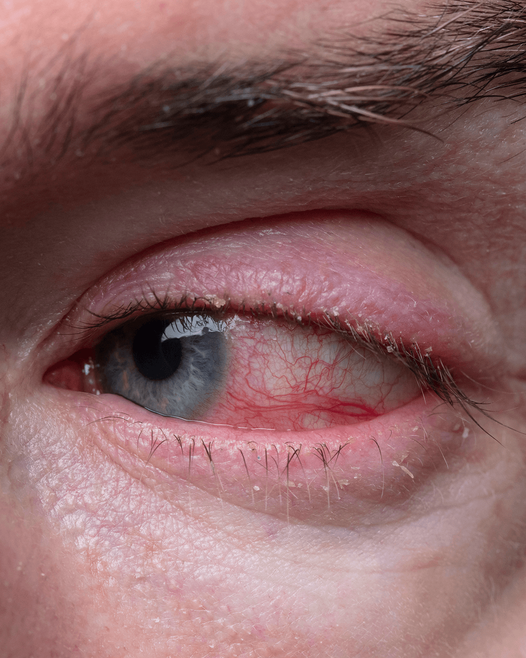 Uveitis inflammation in the eye
