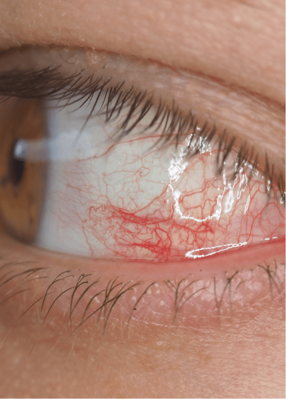 Uveitis eye inflammation treatment