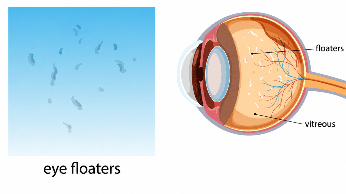 Vitrectomy for eye floaters
