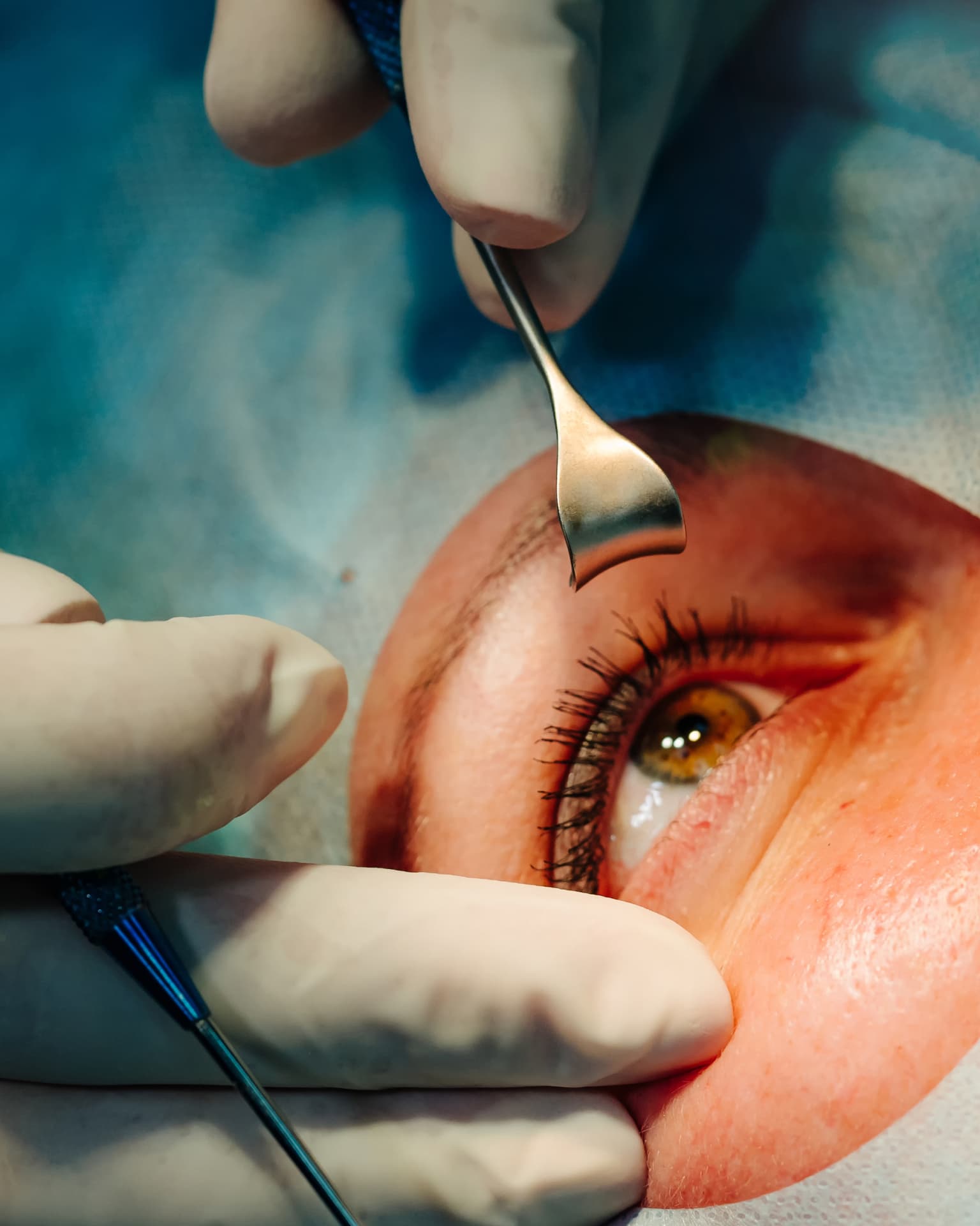 Specialist vitreoretinal surgery for retinal detachment and complex retinal conditions at The Eye Doctor